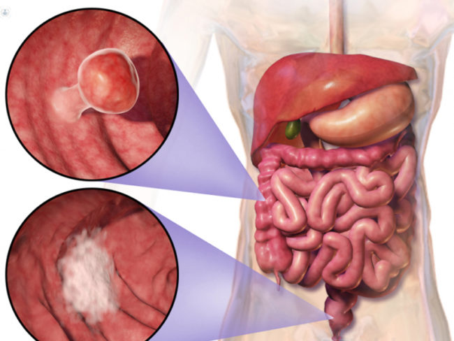 colorectal-cancer