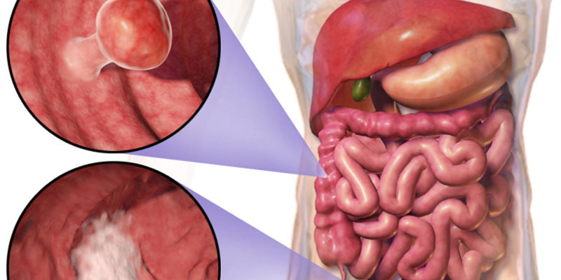 colorectal-cancer